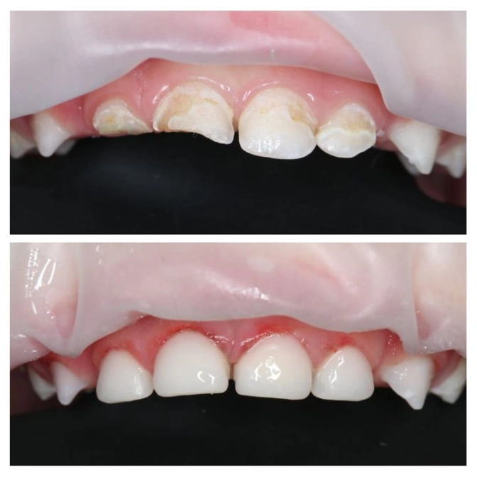 Лечение зубов под наркозом. 