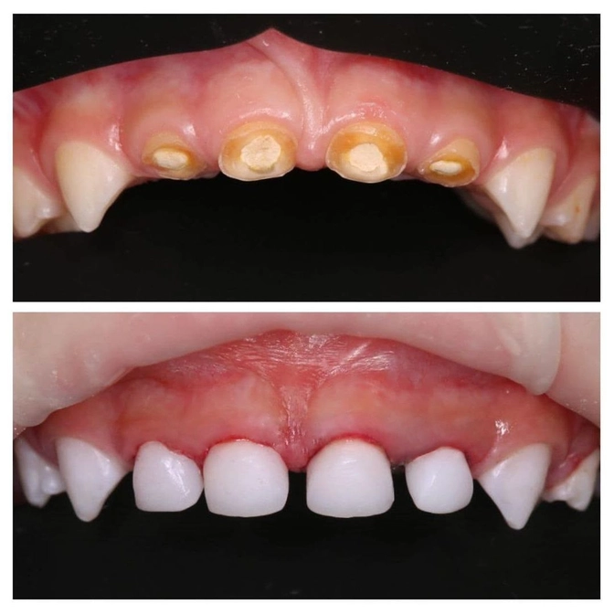 Лечение 16 зубов за одно посещение!  