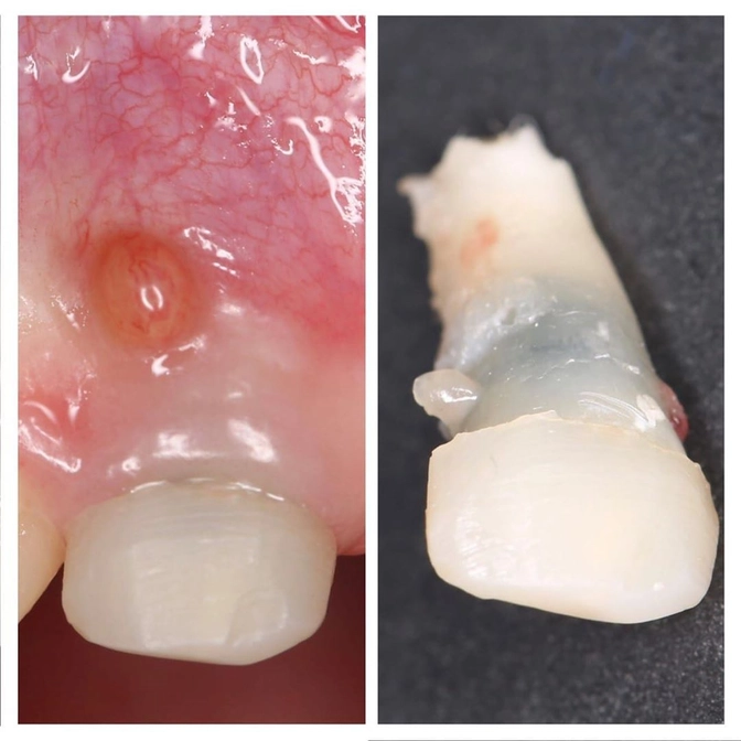 Что делать, если появился свищ? 