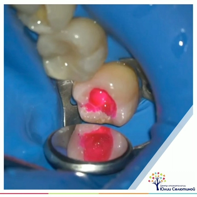 Как врач диагностирует кариес? 