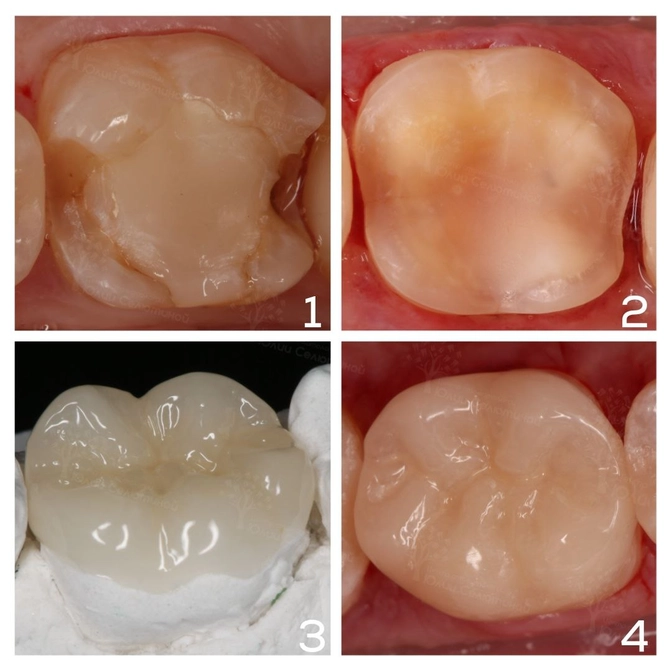 На что поменять большую старую пломбу?