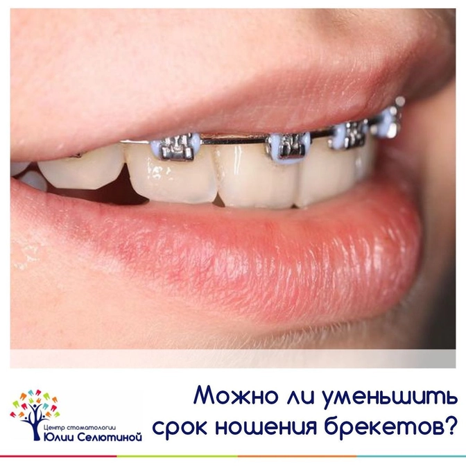 Можно ли уменьшить срок ношения брекетов?