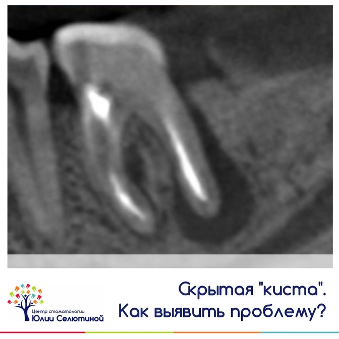 Киста: как выявить проблему?