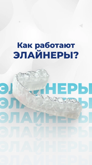 Как работают элайнеры?