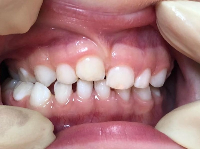 Вколоченный вывих молочного зуба.