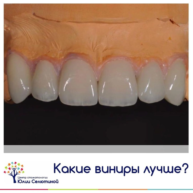 Виниры: какие выбрать? 