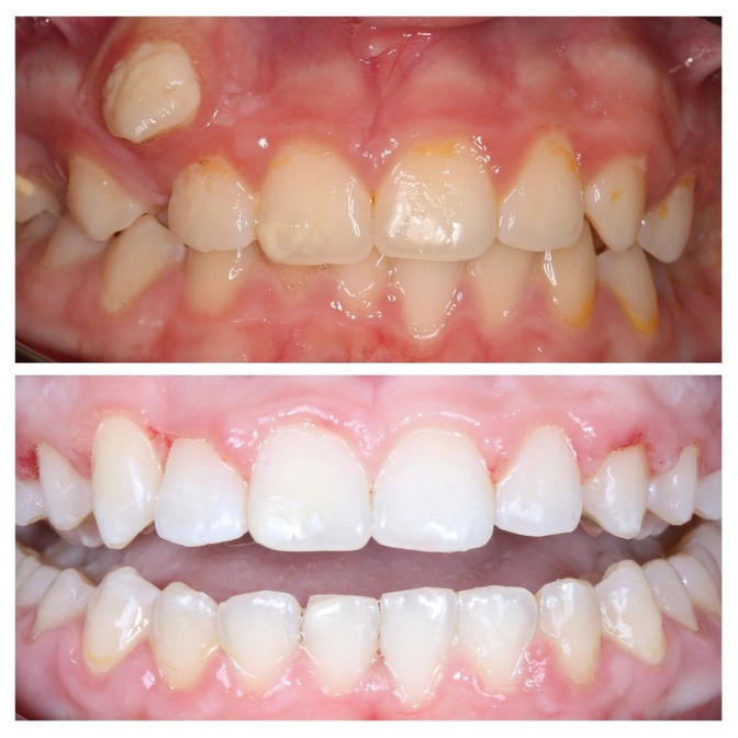 Ортодонтическое лечение. Клинический случай 