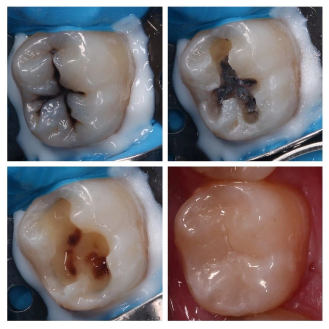 Лечение кариеса постоянного зуба с восстановлением его анатомии. 