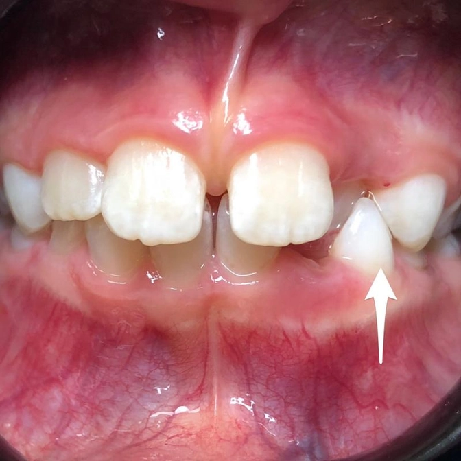 Перекрестный прикус.