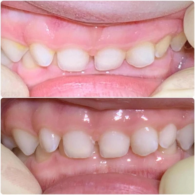 Сверхкомплектный зуб