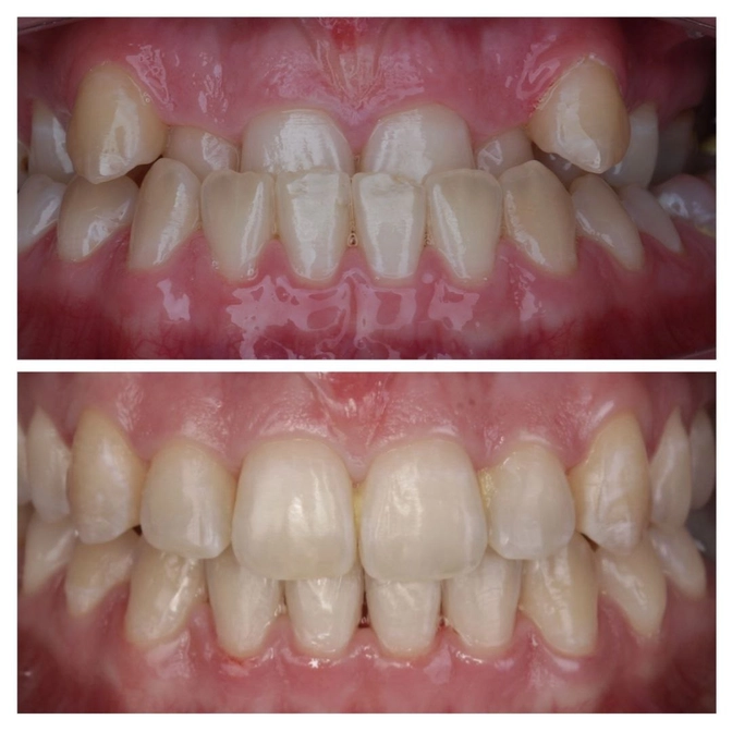 Исправление мезиального прикуса 