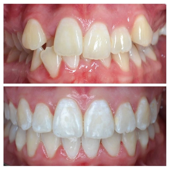 Клинический случай: результат лечения на брекет-системе