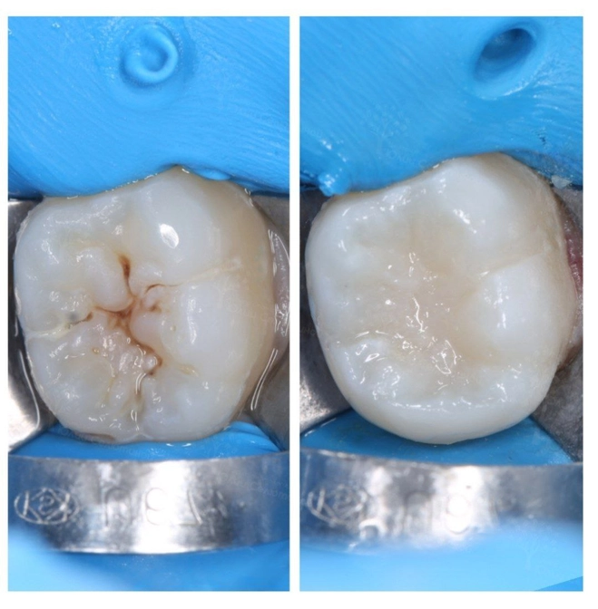 Герметизация фиссур - профилактика кариеса 