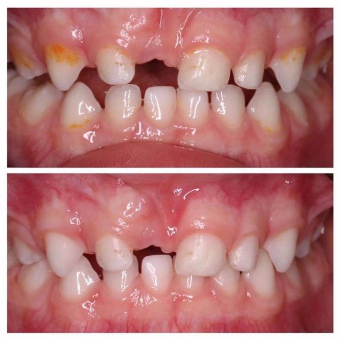 Клинический случай: преждевременная потеря центрального молочного зуба