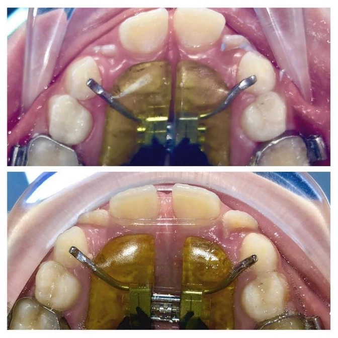 Когда зубам не хватает места...