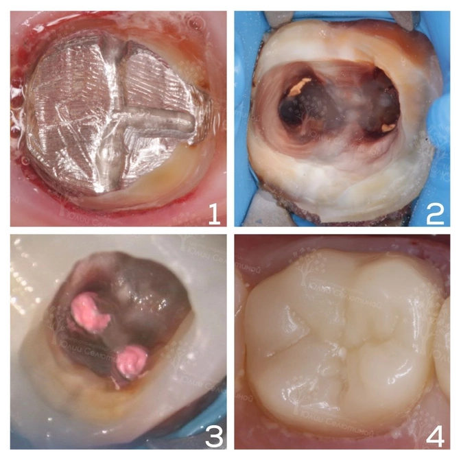 Перелечивание зуба с металлической вкладкой 