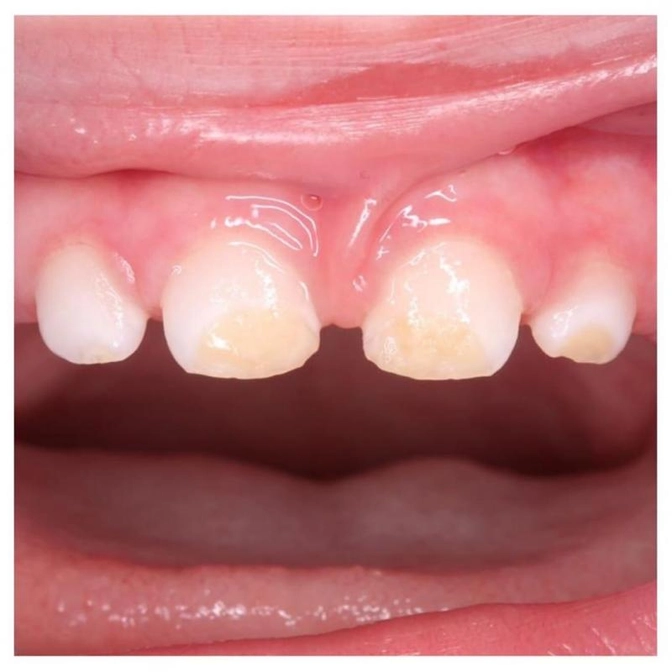 Бывает ли гипоплазия эмали у малышей?