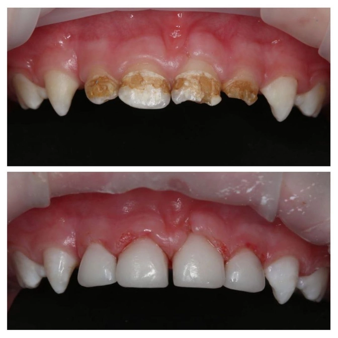 Гипоплазия молочных зубов. 
