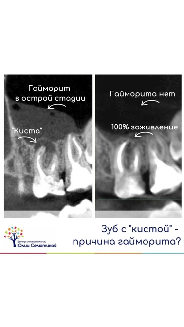 Может ли зуб с "кистой" быть причиной гайморита? 