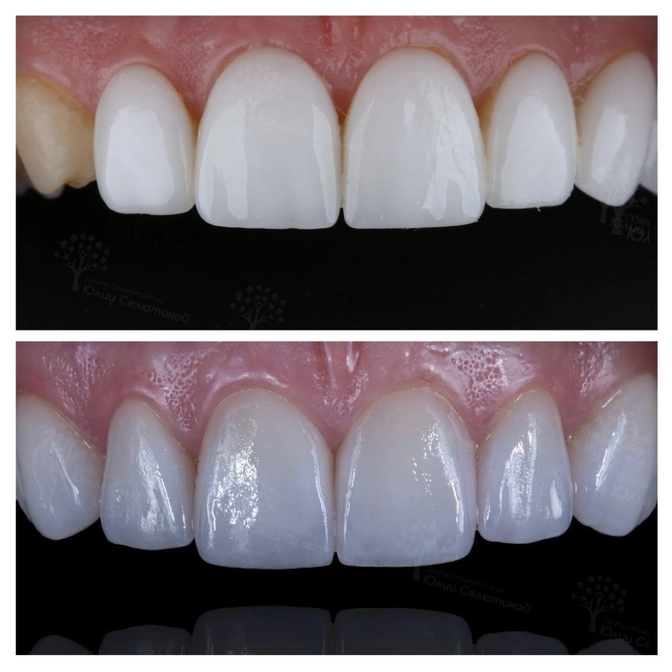 Замена виниров