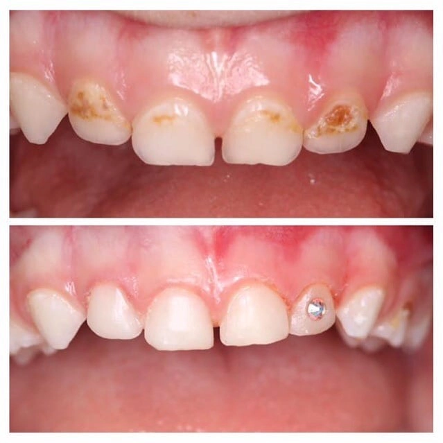 "Бриллианты" на зубах.