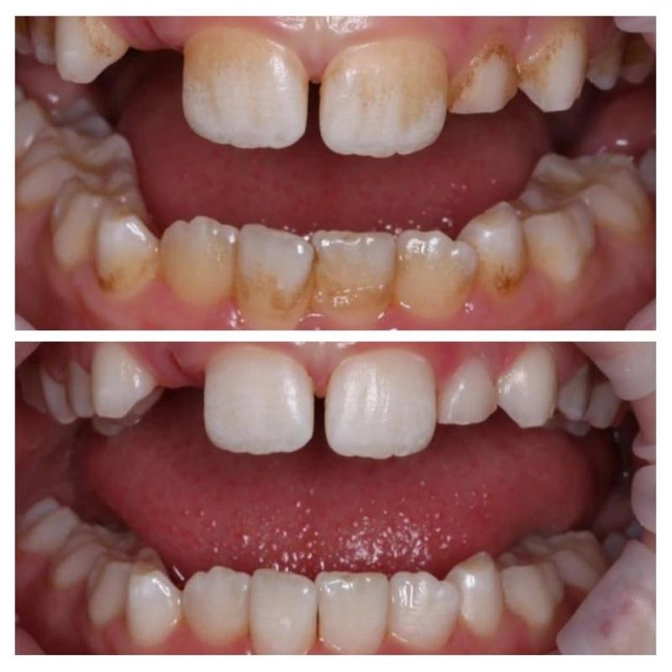 Как железо влияет на зубы?