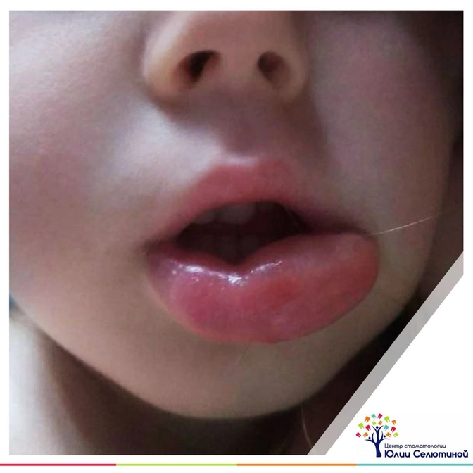 Что делать, если ребёнок накусал щеку после лечения? 