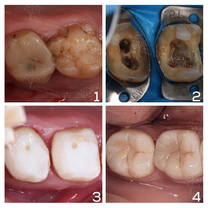 Почему вкладка лучше, чем пломба? 