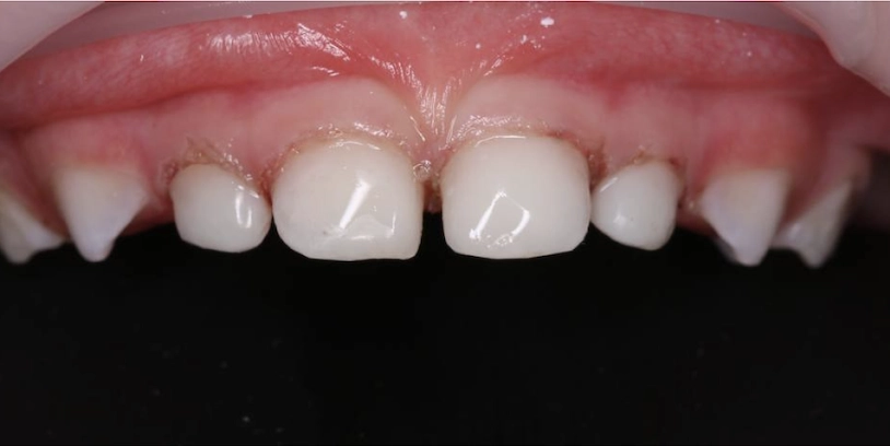 Изображение зубов после выполненой работы