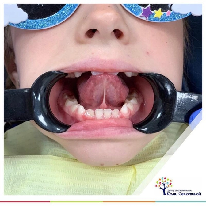 Короткая уздечка языка.