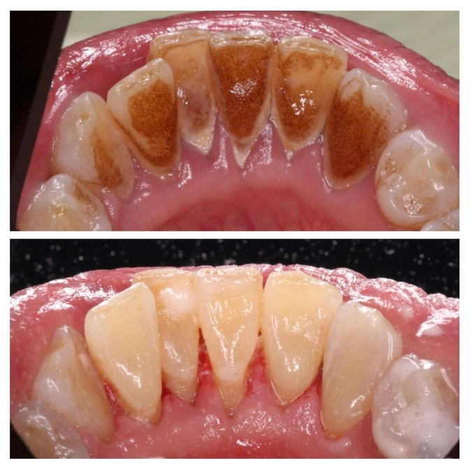 Этапы профессиональной гигиены полости рта