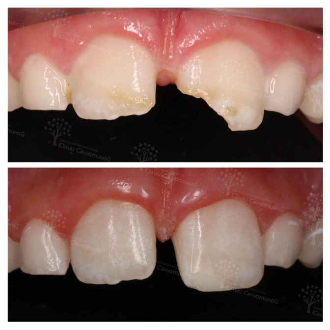 Клинический случай: скол постоянного зуба у ребёнка 