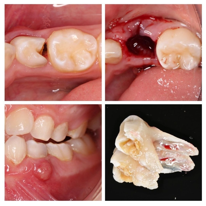 Свищ: тактика лечения молочных зубов. 