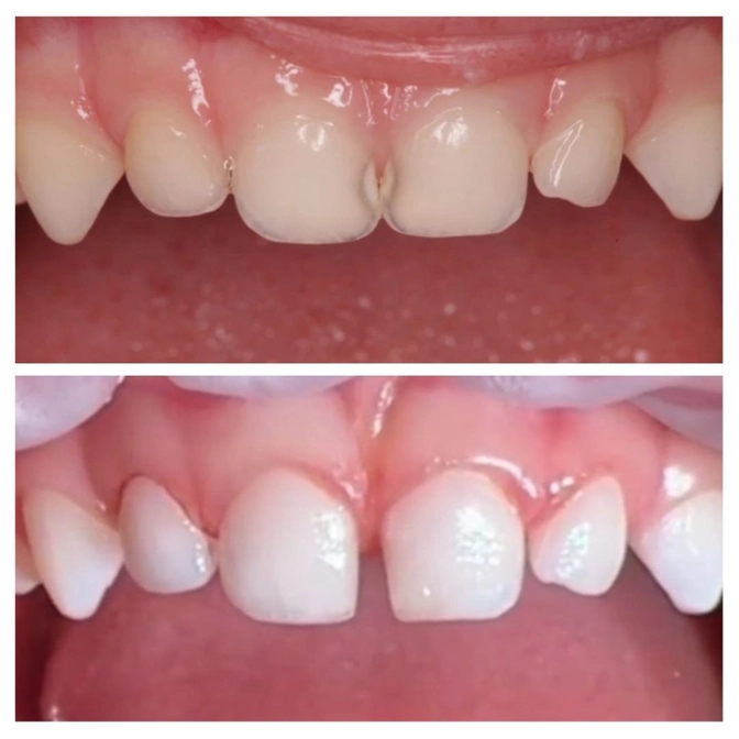 Лечение агрессивного кариеса у малыша 