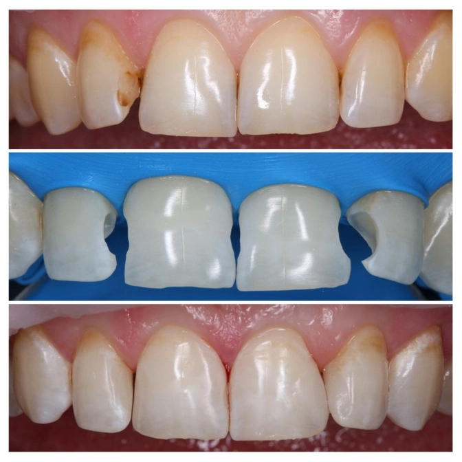 Лечение контактного кариеса центральных зубов 