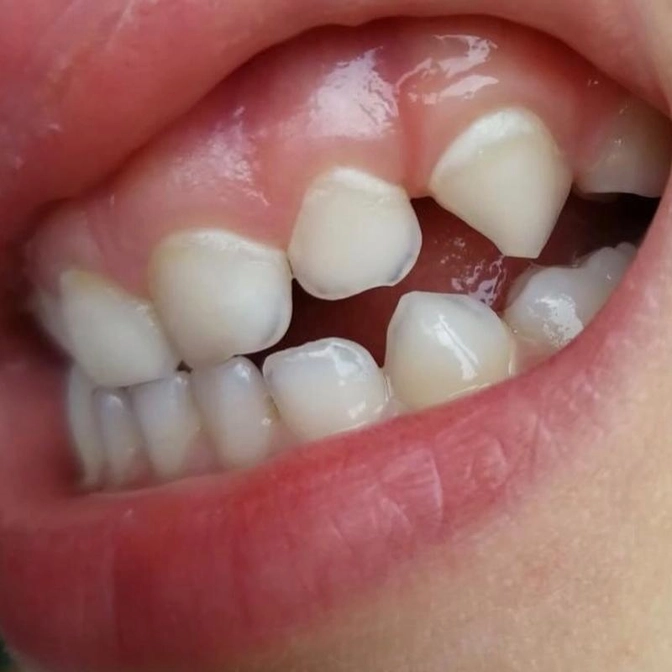 Кариес в стадии пятна.