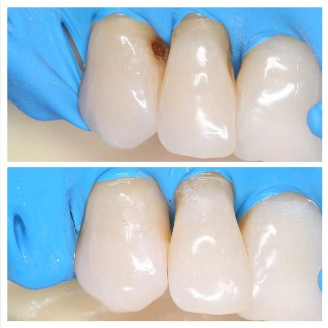 Лечение кариеса постоянного зуба. 