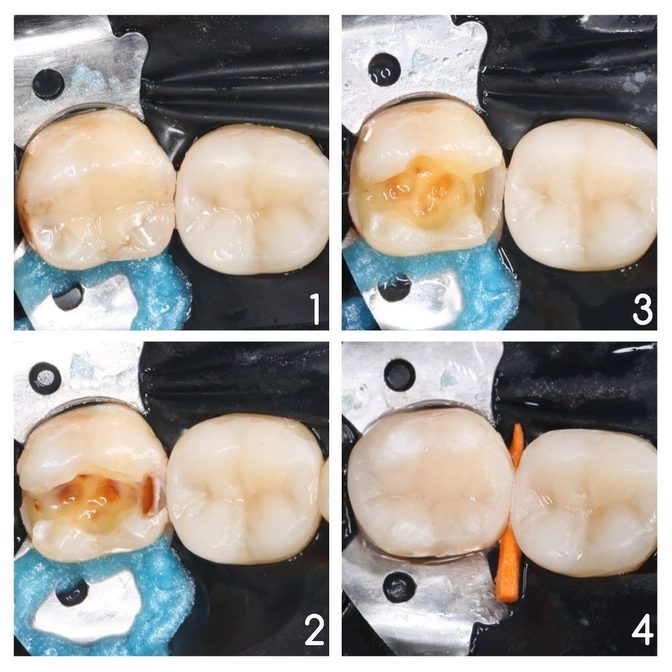Зачем менять старые пломбы?