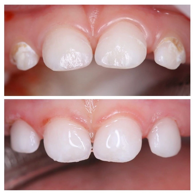 Лечение молочных зубов малышу под наркозом 