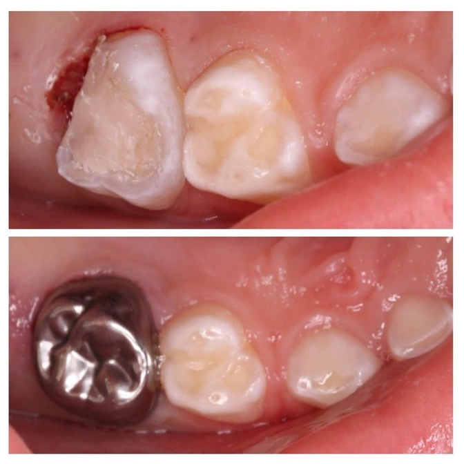 Коронки на молочные зубы.