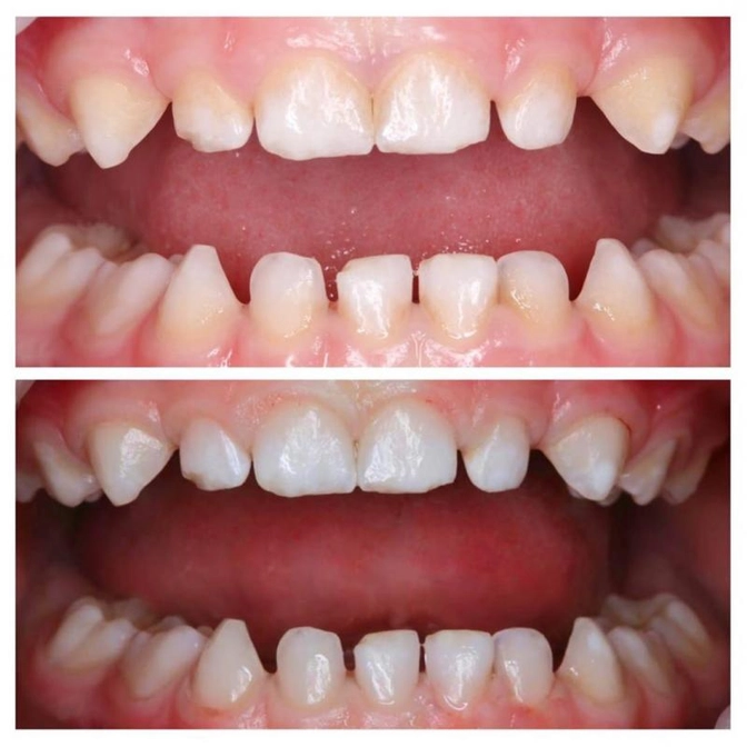 Что влияет на цвет зубного налета?