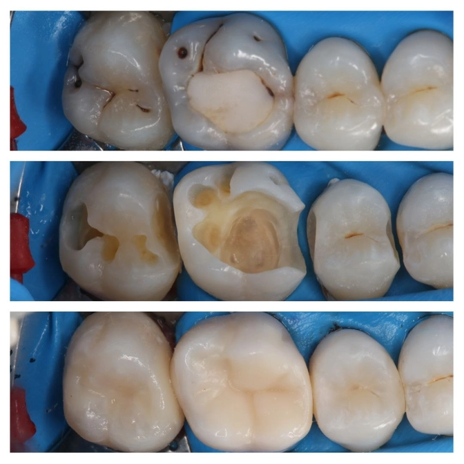Лечение нескольких зубов в одно посещение 