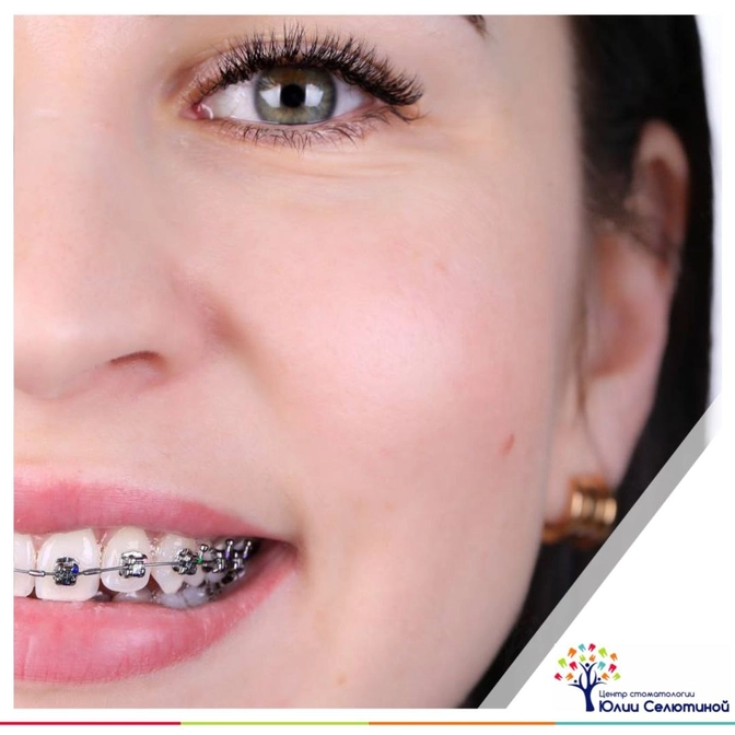 Ношу брекеты: как это ощущается? 