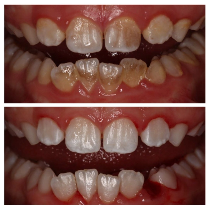 Профессиональная гигиена у подростка