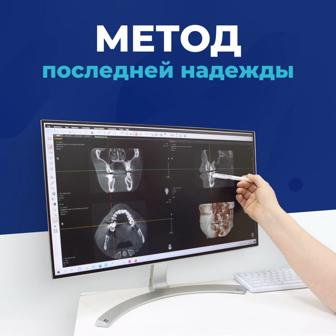 Метод последней надежды