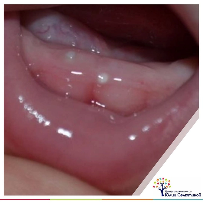 "Жемчужинки" на деснах малыша - что это?
