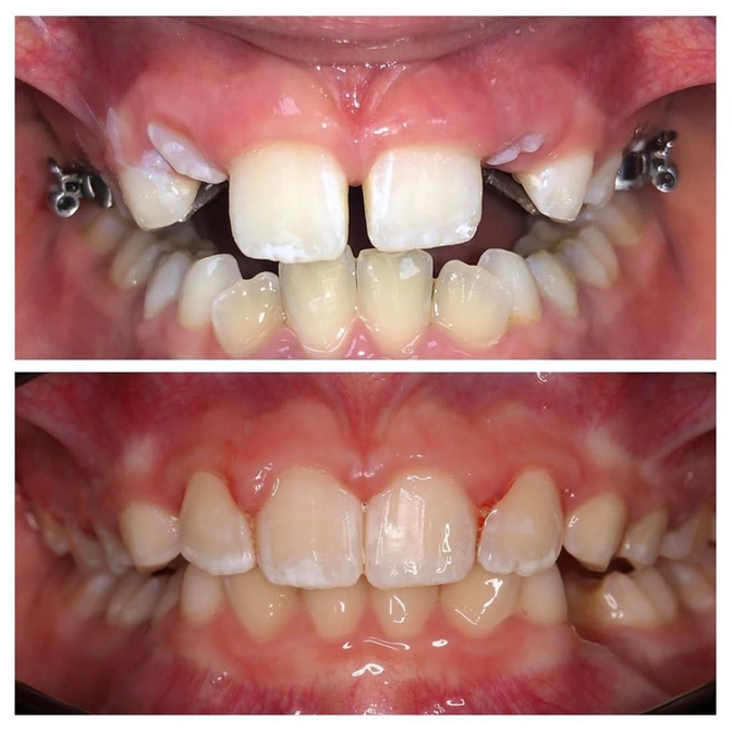 Ортодонтическое лечение в сменном прикусе.