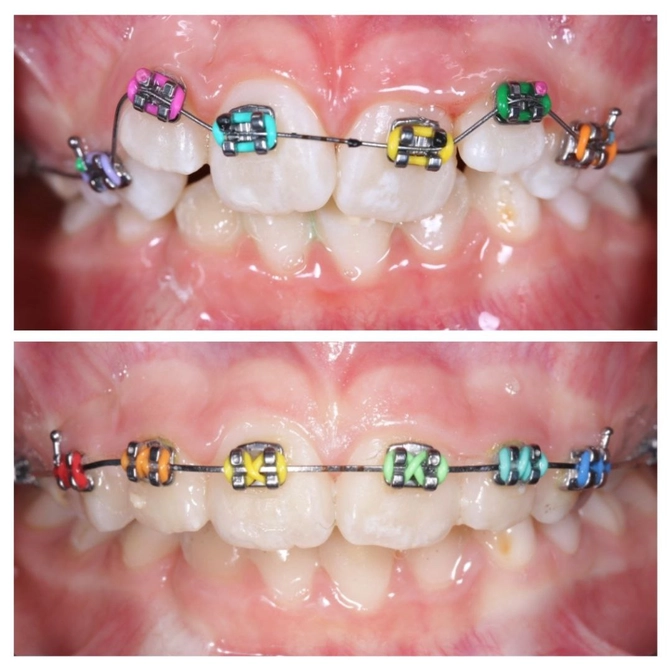 Лечение на брекетах в сменном прикусе 