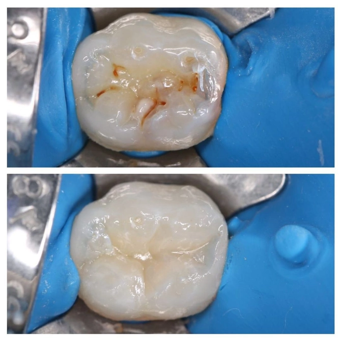 Лечение молочной "пятерки": кариес жевательного зуба.
