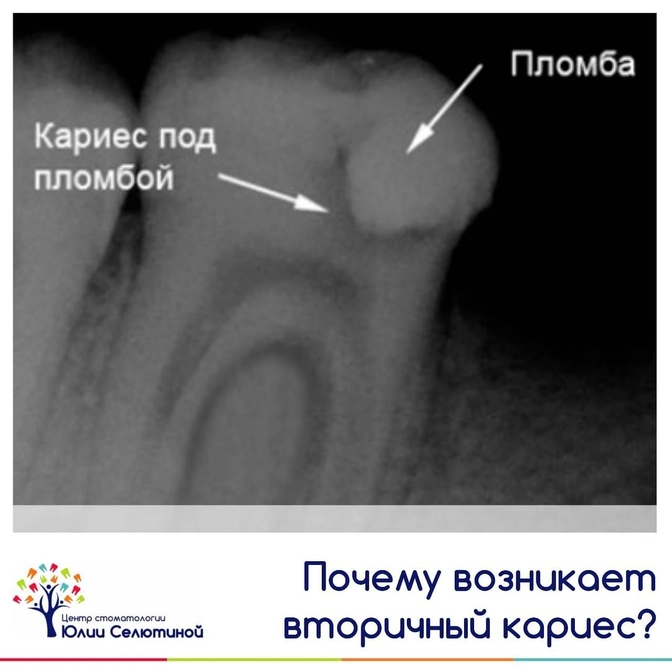 Почему возникает вторичный кариес? 